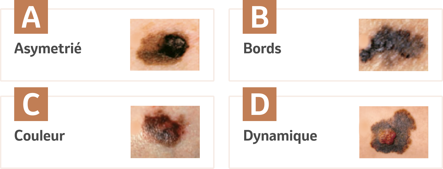 ABCD Melanoma