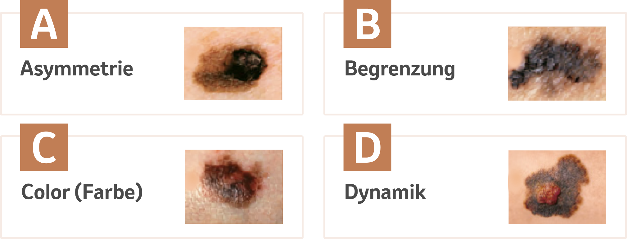 ABCD Melanoma