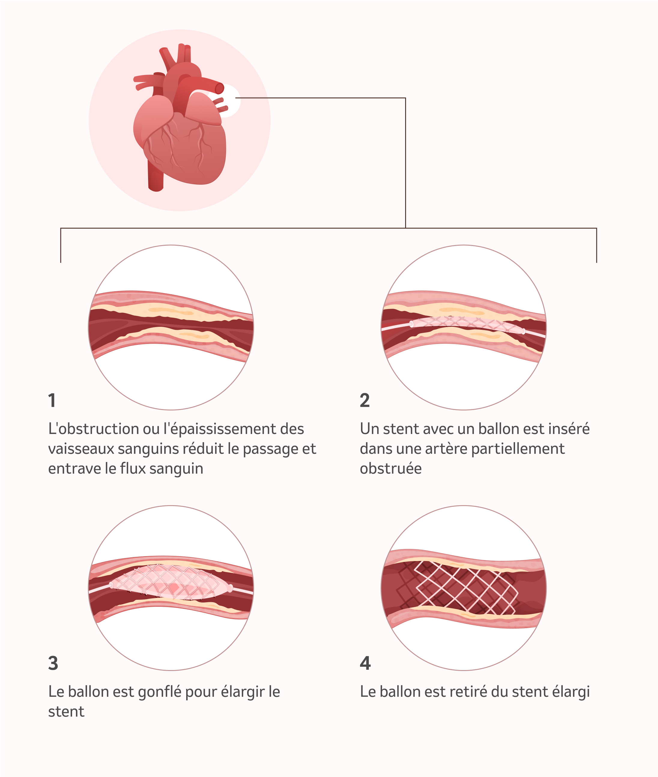 Image: l'angioplastie pulmonaire par ballon