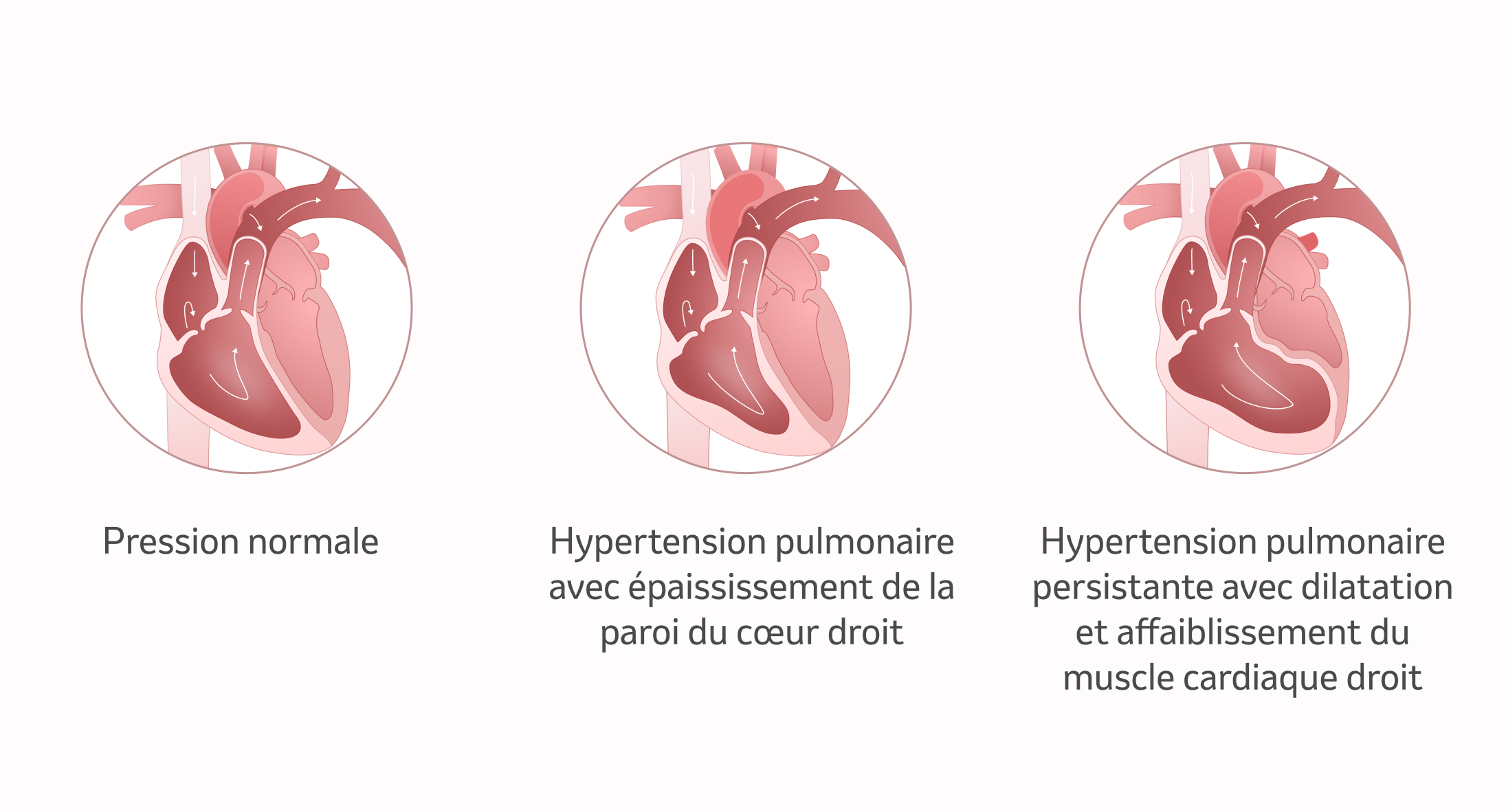 image: Le cœur avec l'HTP