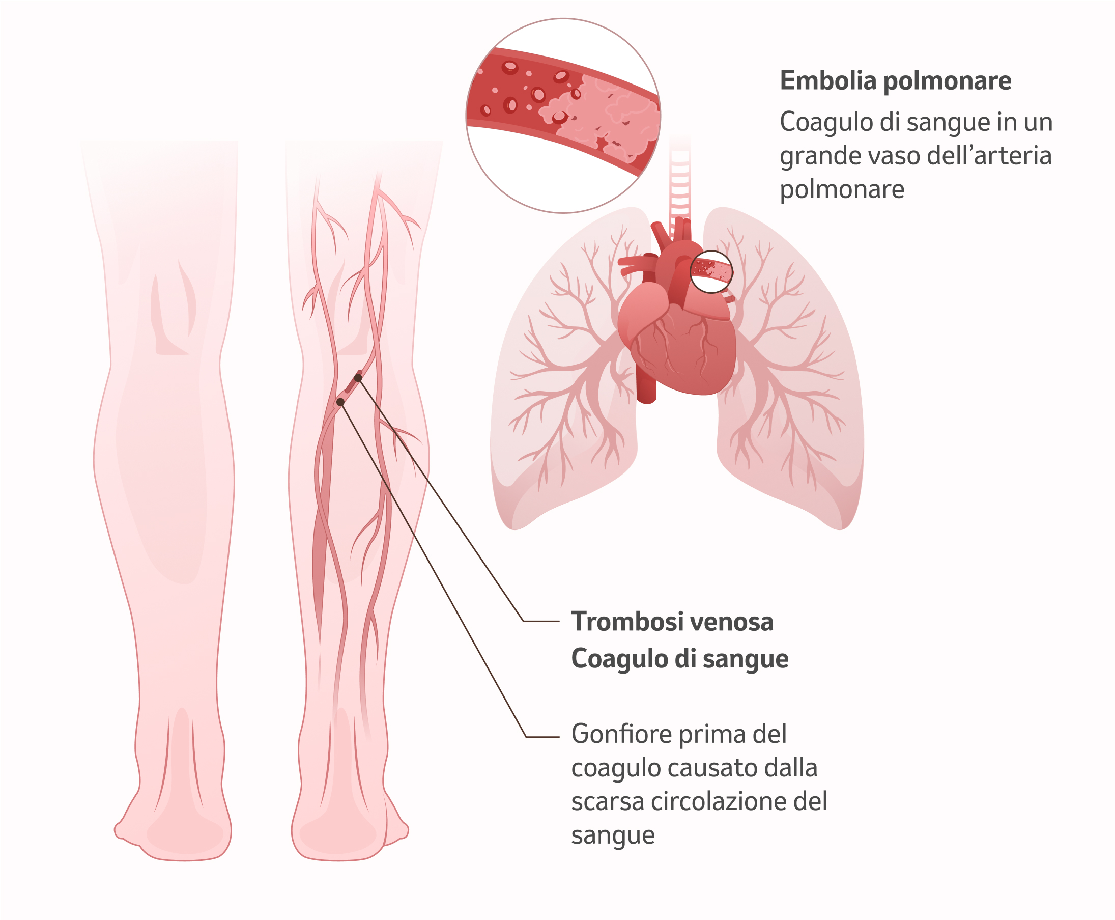 Immagine: Embolia polmonare, trombosi venosa e coaguli di sangue