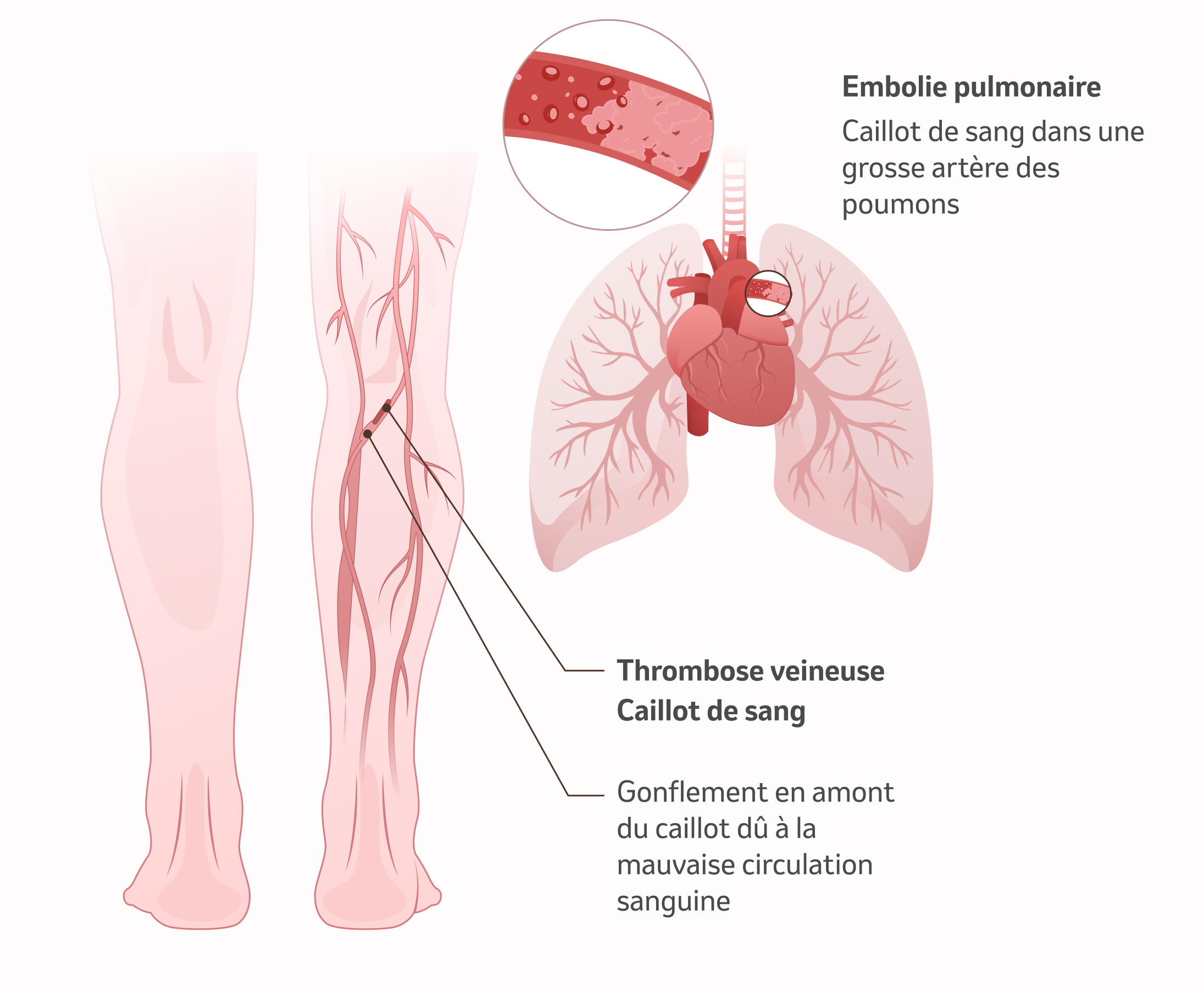 Image : Embolie pulmonaire, thrombose veineuse et caillots sanguins