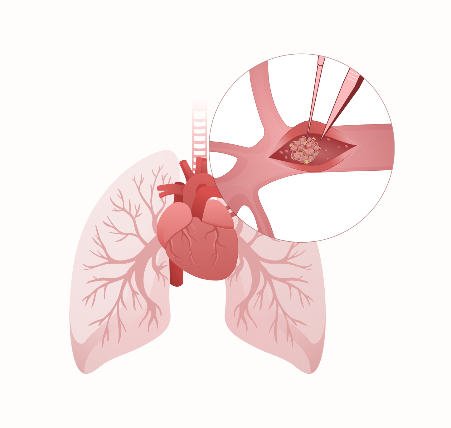 Image : L'endartériectomie pulmonaire