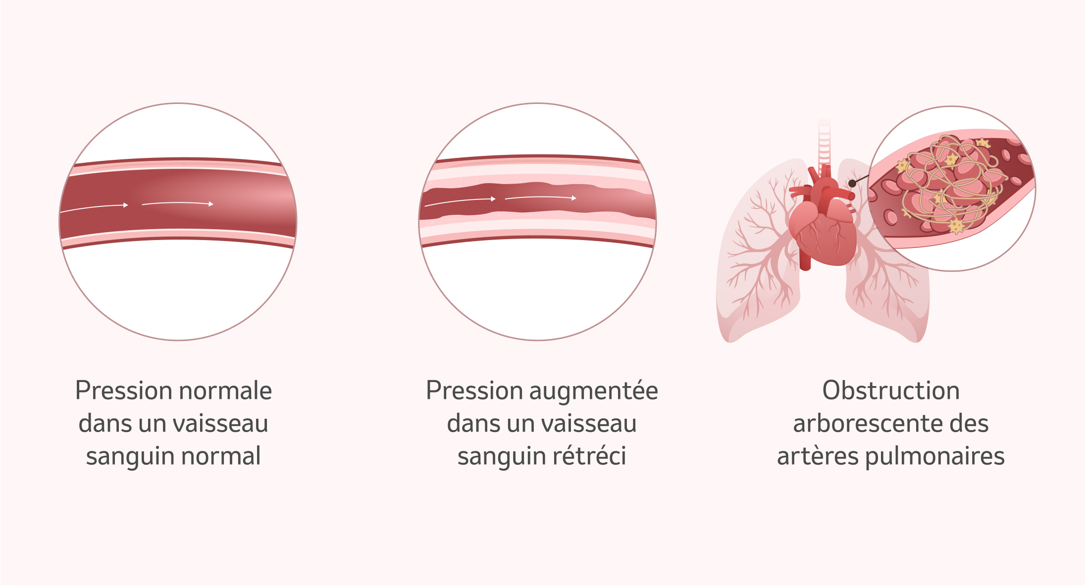 Image: Modifications des vaisseaux sanguins