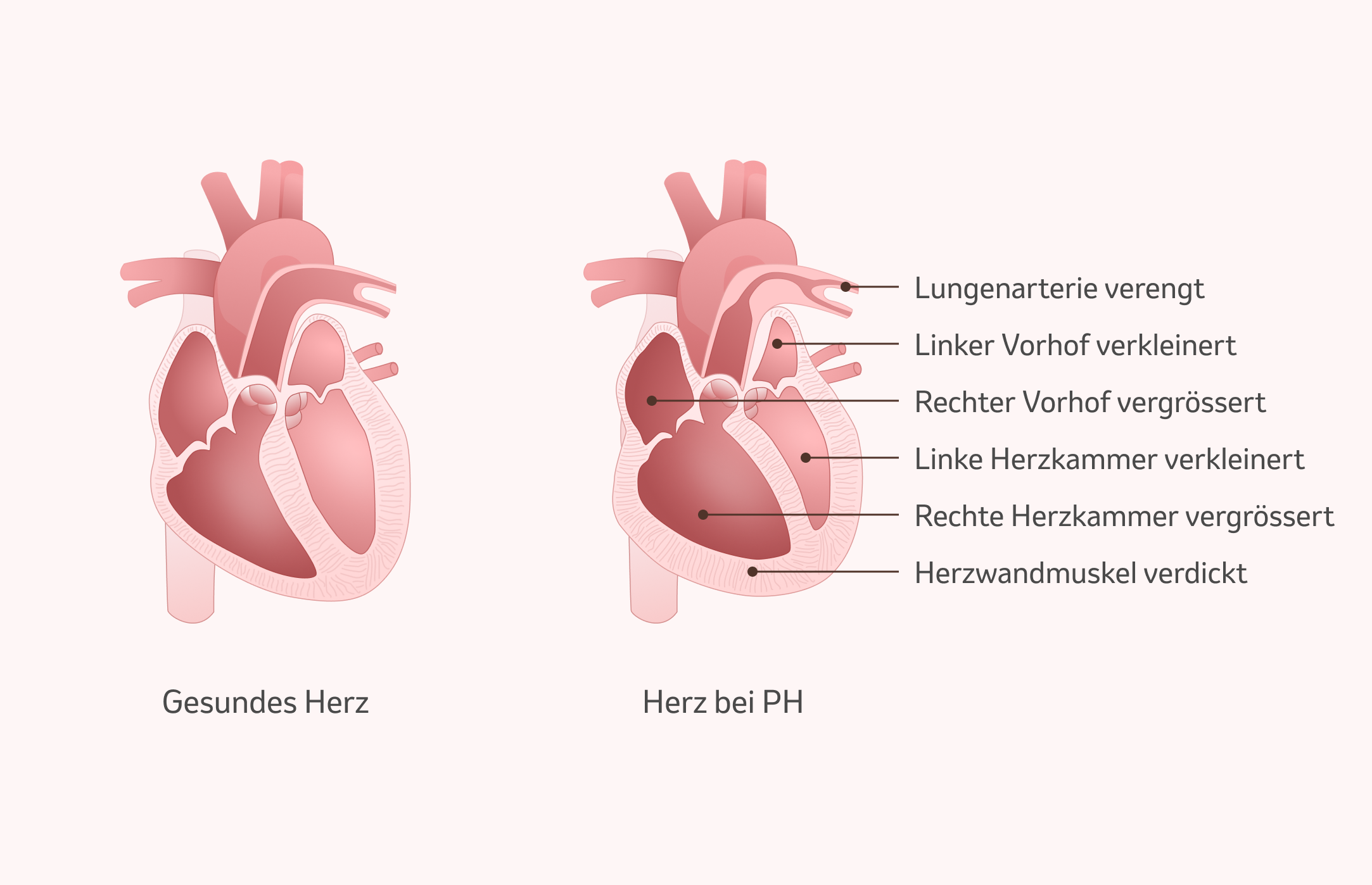 Bild: Folgen des Lungenhochdrucks auf das Herz