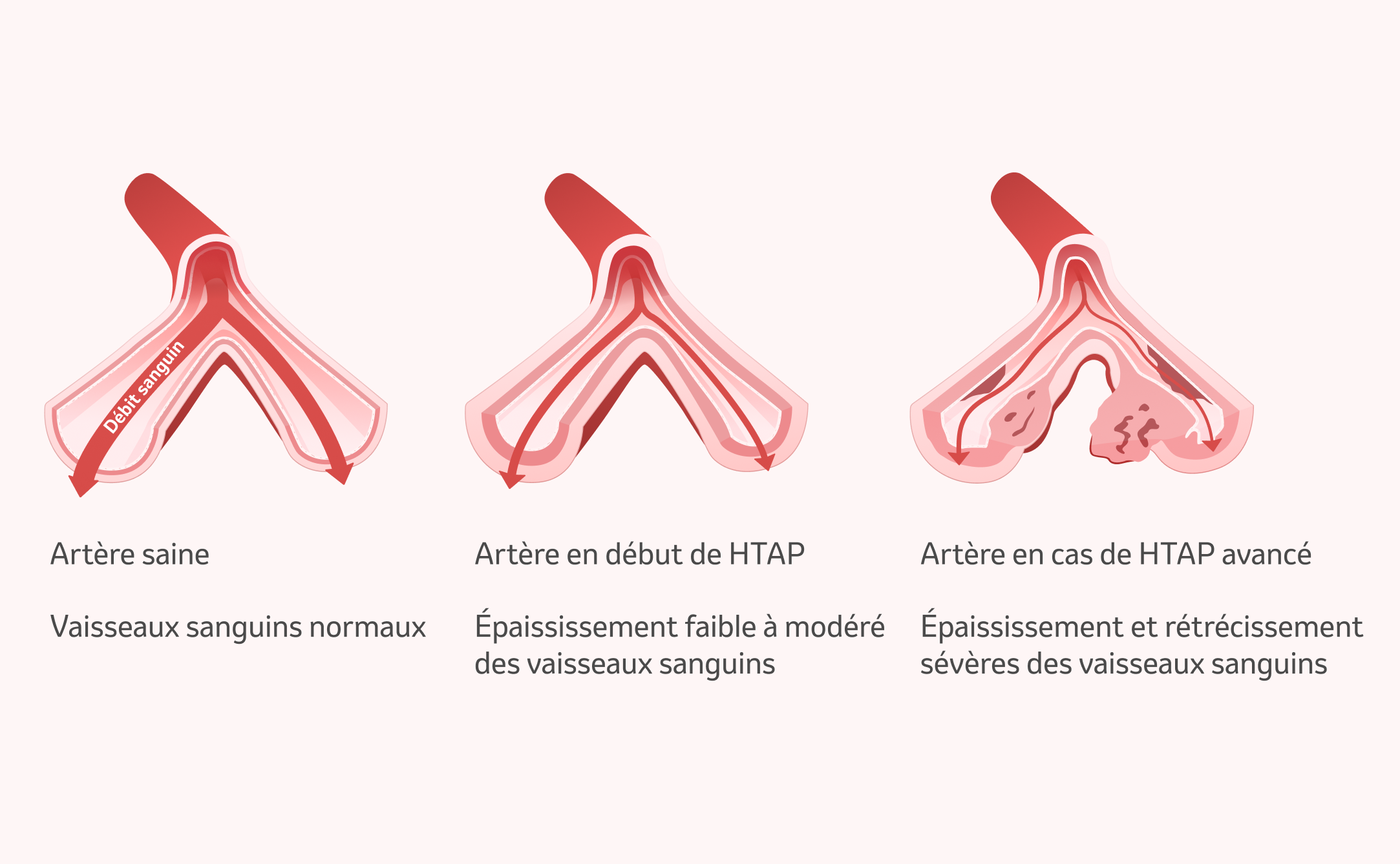 Image : Modification des artères pulmonaires lors d'une HTAP