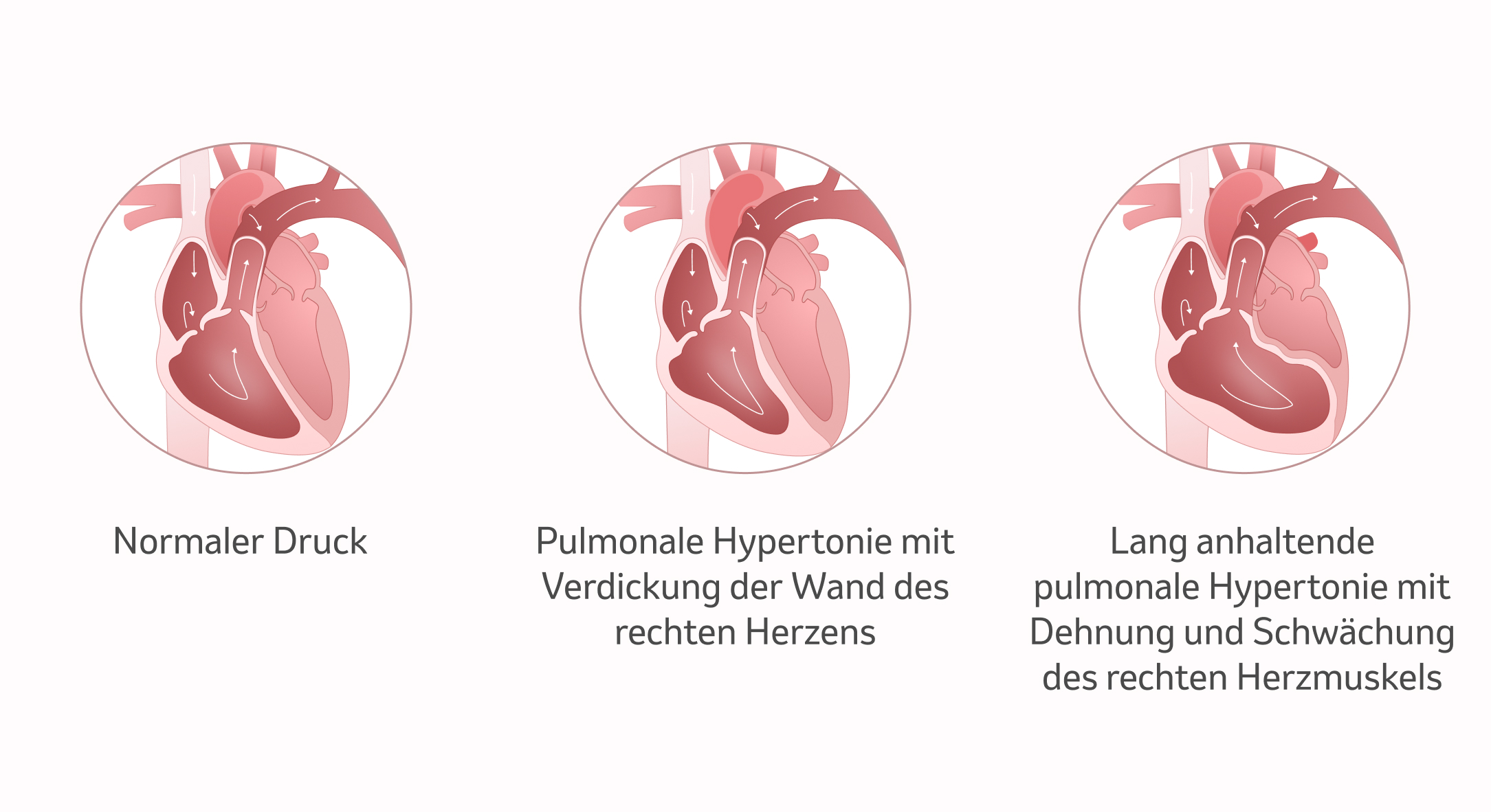 Bild: Herz bei PH