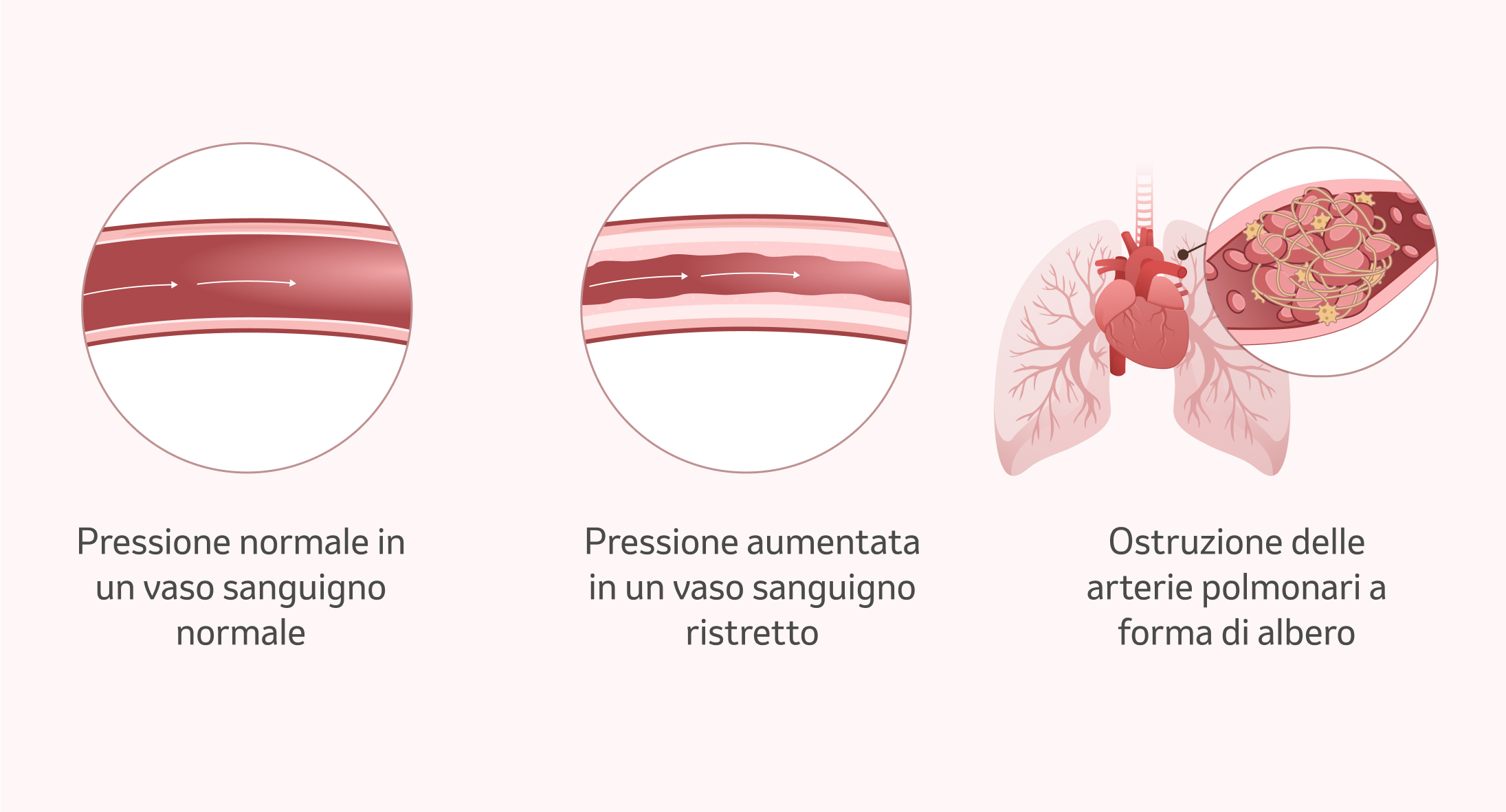 Immagine: cambiamenti nei vasi sanguigni