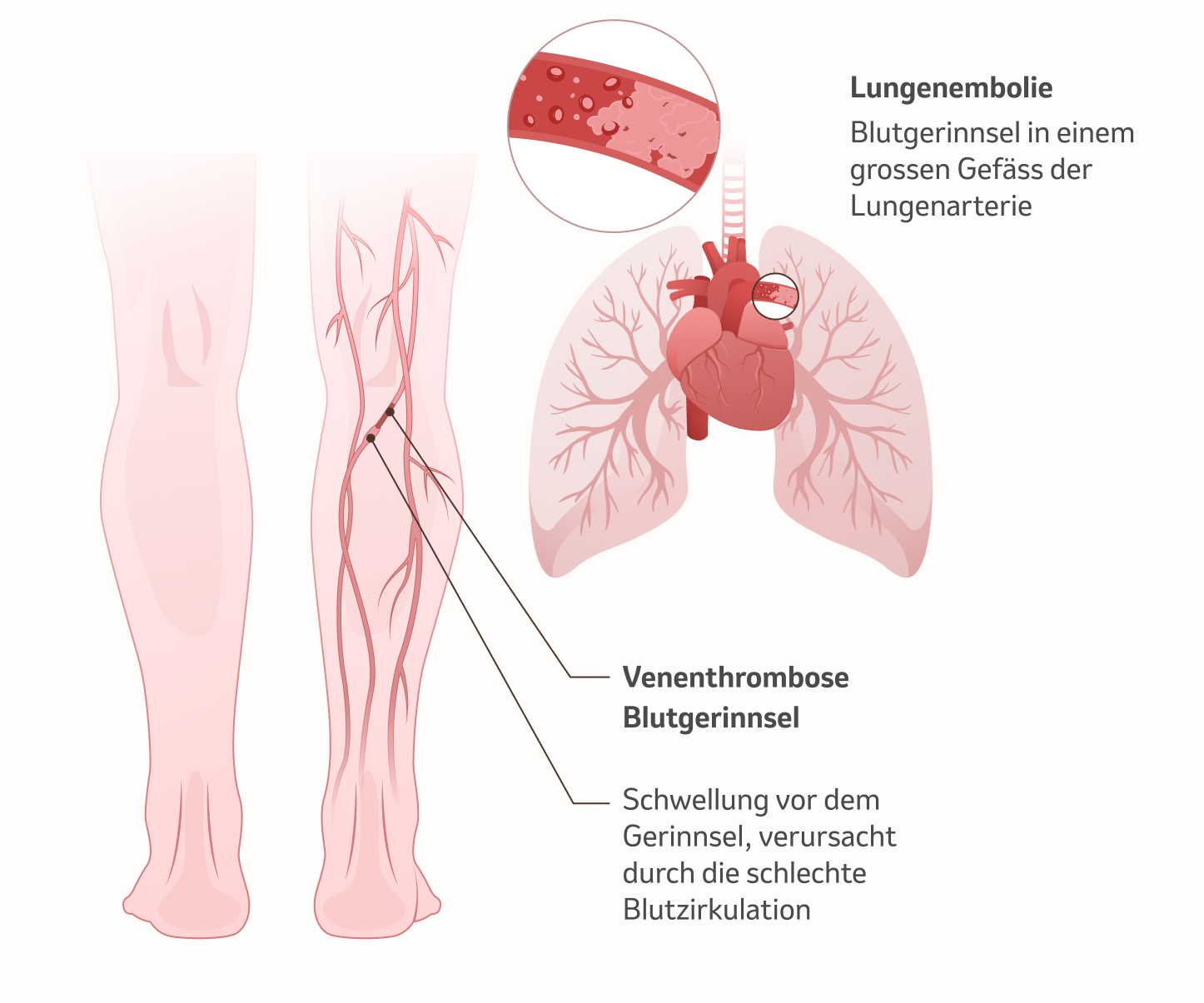 Bild: Lungenembolie, Venenthrombose und Blutgerinnsel 