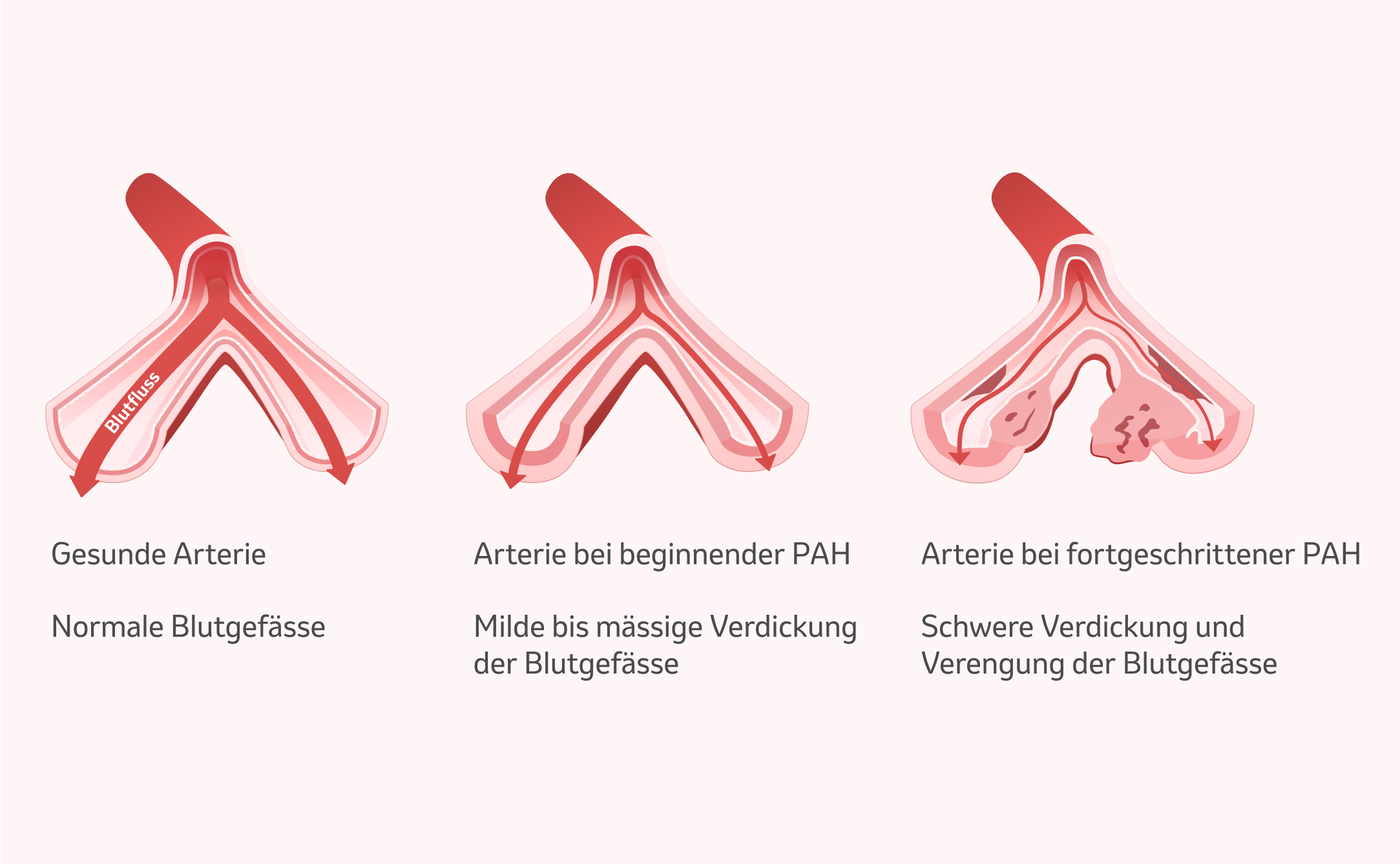 Bild: Veränderung der Lungenarterien bei der PAH