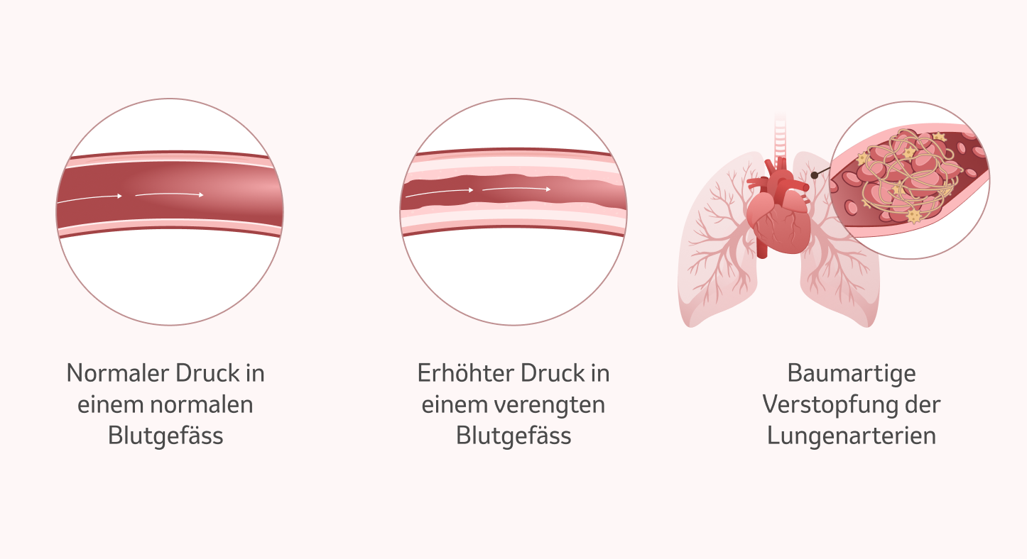 Bild: Veraenderungen der Blutgefaesse